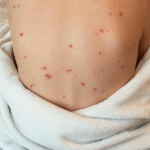 A person showing a back covered in numerous red spots, indicating a possible skin condition like chicken pox