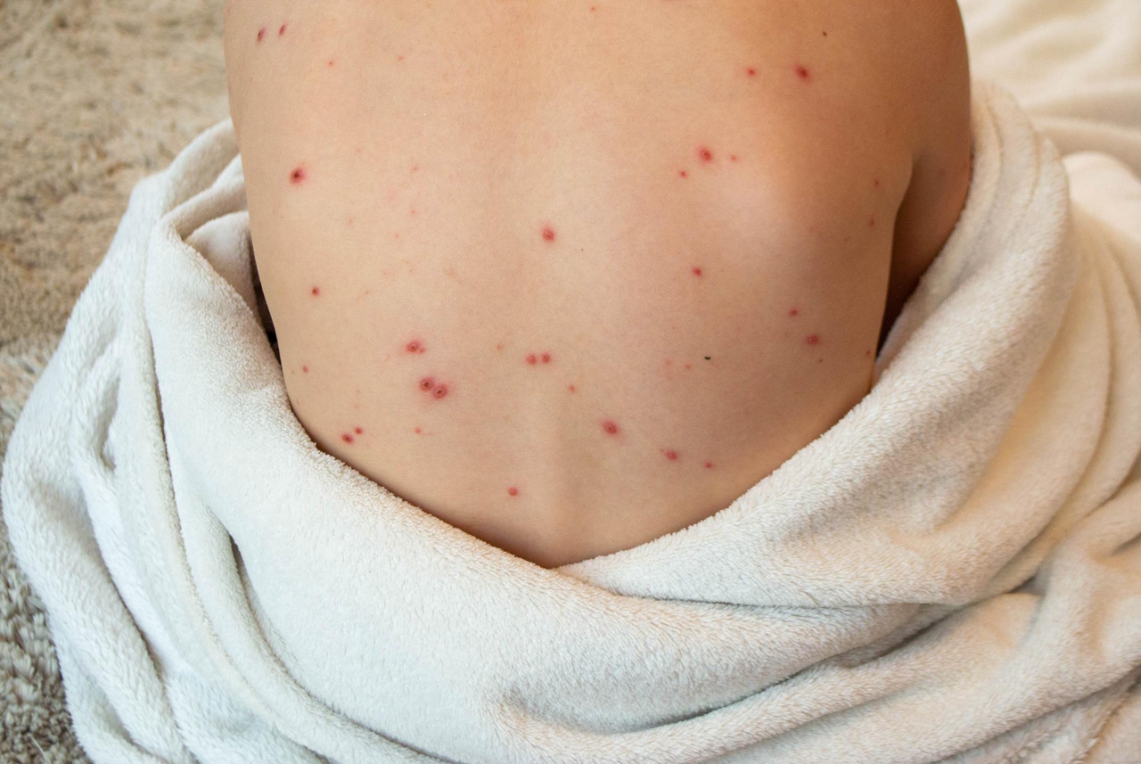 What Does Chickenpox Look Like? Rash Stages and Visuals