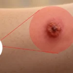 Close-up of a skin lesion with a diagram of skin layers.