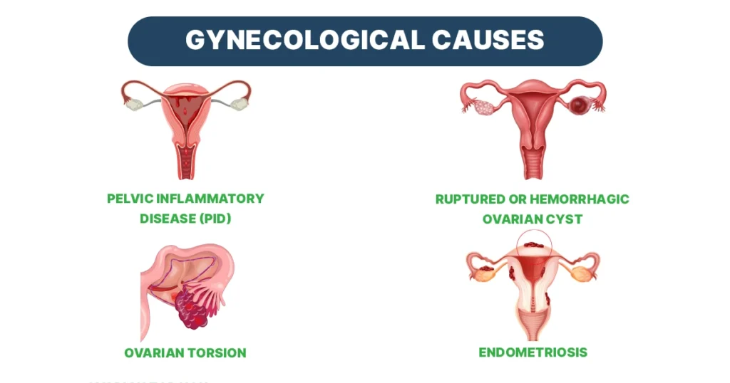 Illustration of the large intestine showing diverticulitis, IBD, and IBS causes.