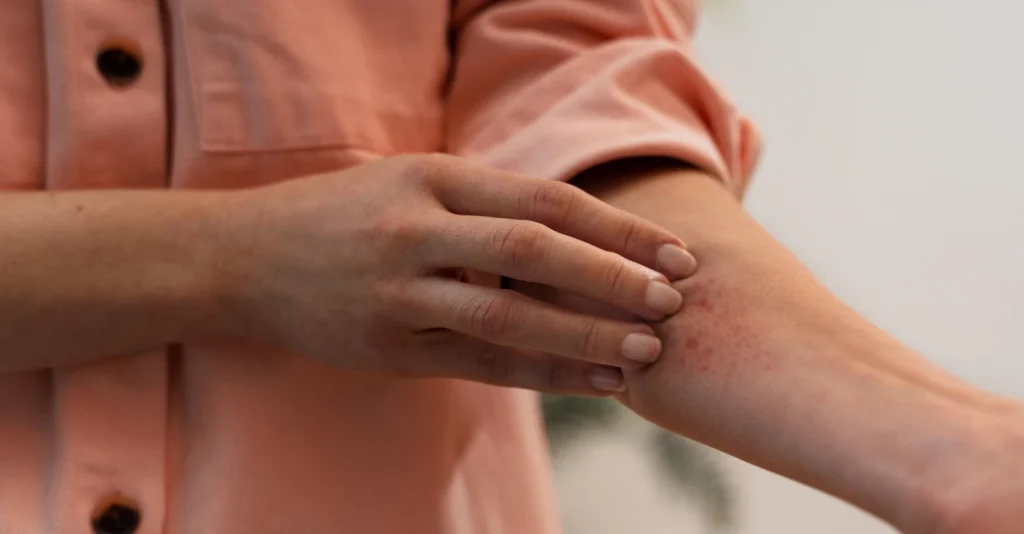 rosacea_skin_condition