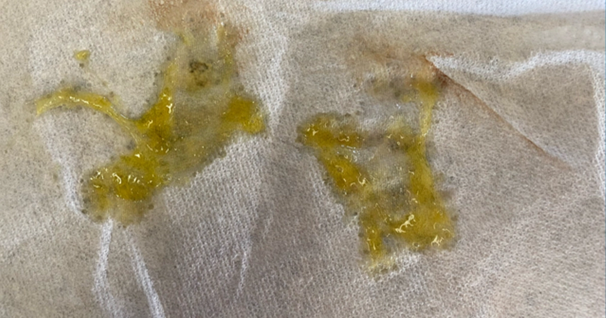 Why Is My Mucus Yellow