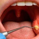 Tonsil stone visible in throat during oral exam.