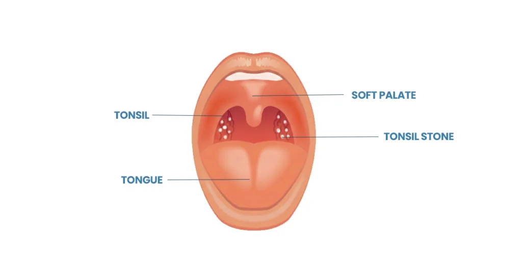 Diagram showing tonsil stones inside the throat anatomy.