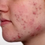 Acne breakout triggered by irritated skin.