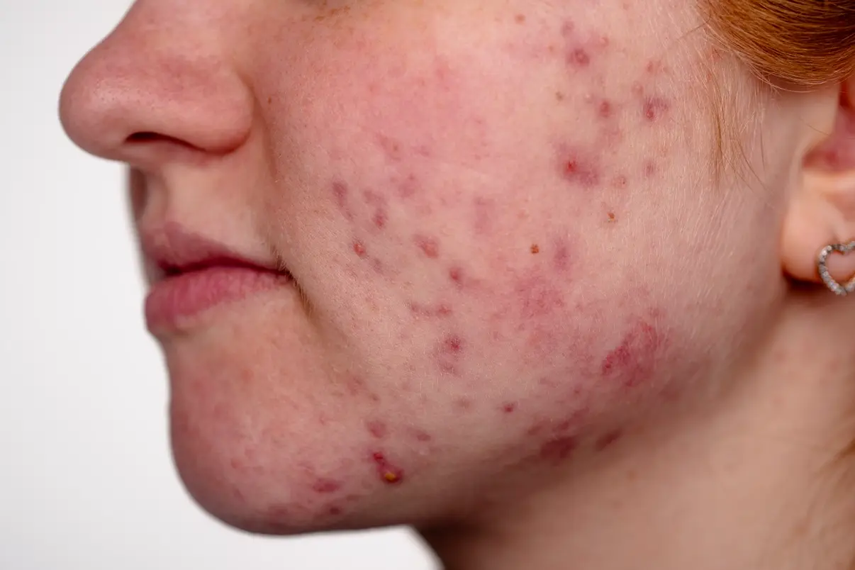 Can Skin Irritation Cause Acne