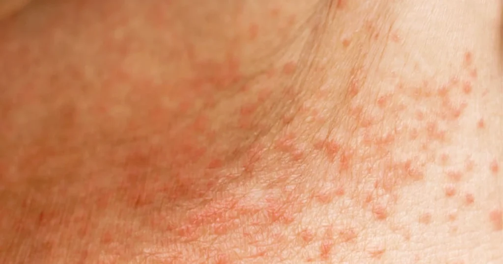 Close-up of heat rash with red bumps on skin.
