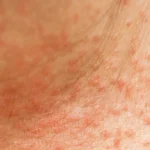 Close-up of heat rash with red bumps on skin.