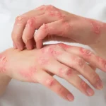 Close-up of hands with red, inflamed, dry, and peeling skin showing visible skin irritation and rash patches.