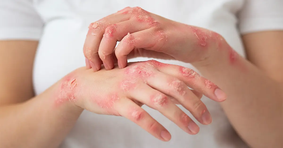 Skin Infections