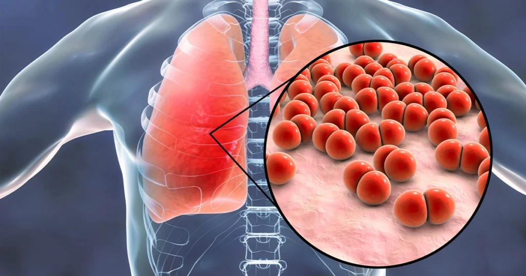 Bacterial infection in lungs causing walking pneumonia symptoms.