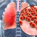 Bacterial infection in lungs causing walking pneumonia symptoms.