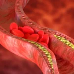 Illustration of a blood clot forming inside a blood vessel.