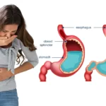 Woman clutching abdomen with labelled acid reflux diagram.