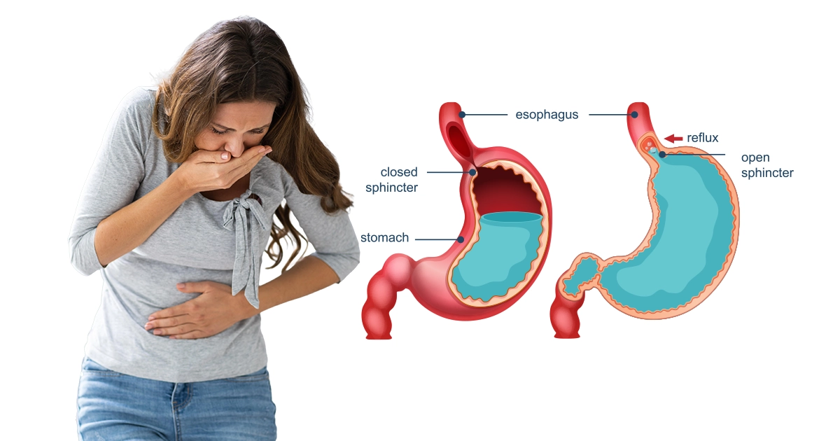 Can GERD Cause Nausea