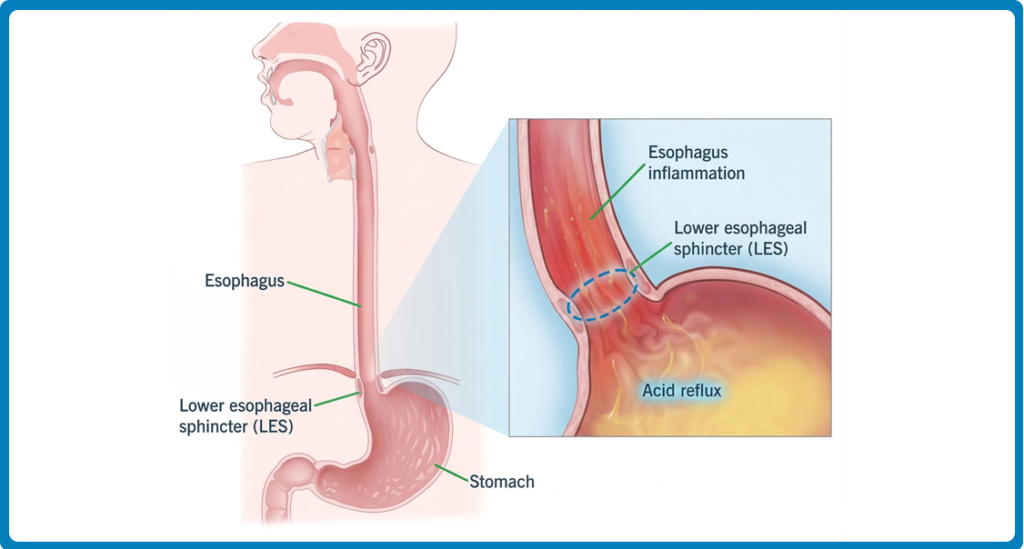 A medical illustration of the upper digestive system showing acid reflux moving from the stomach into the esophagus.