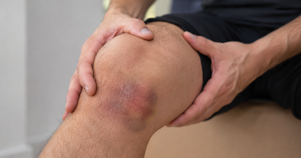 Man holding a bruised knee from a soft tissue injury.