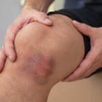 Man holding a bruised knee from a soft tissue injury.
