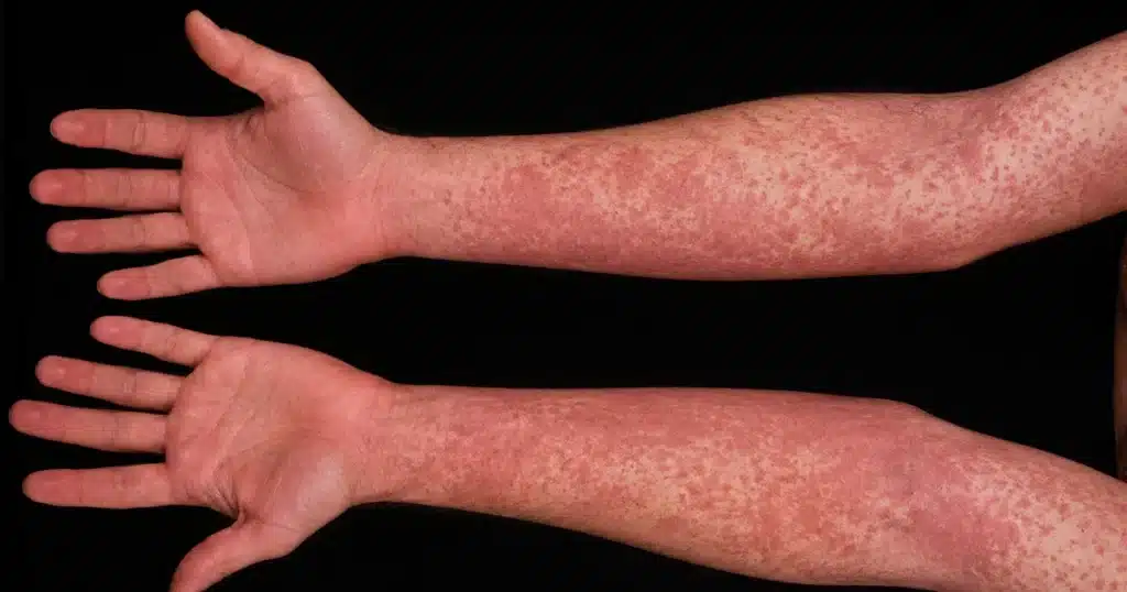 Red rash on both arms.