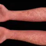 Red rash on both arms.