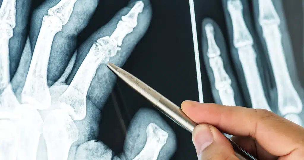 Hand X-ray showing a finger fracture highlighted with a medical pointer.