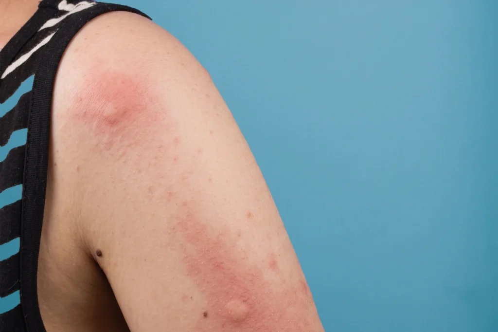 Swollen, red mosquito bite reaction on a person's upper arm.