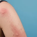 Swollen, red mosquito bite reaction on a person's upper arm.