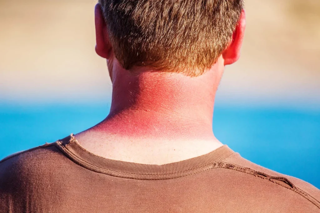 Rear view of a man with inflamed, red skin on the back of his neck caused by a severe sunburn, with blue water in the blurred background.