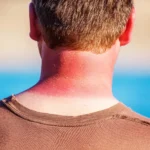 Rear view of a man with inflamed, red skin on the back of his neck caused by a severe sunburn, with blue water in the blurred background.