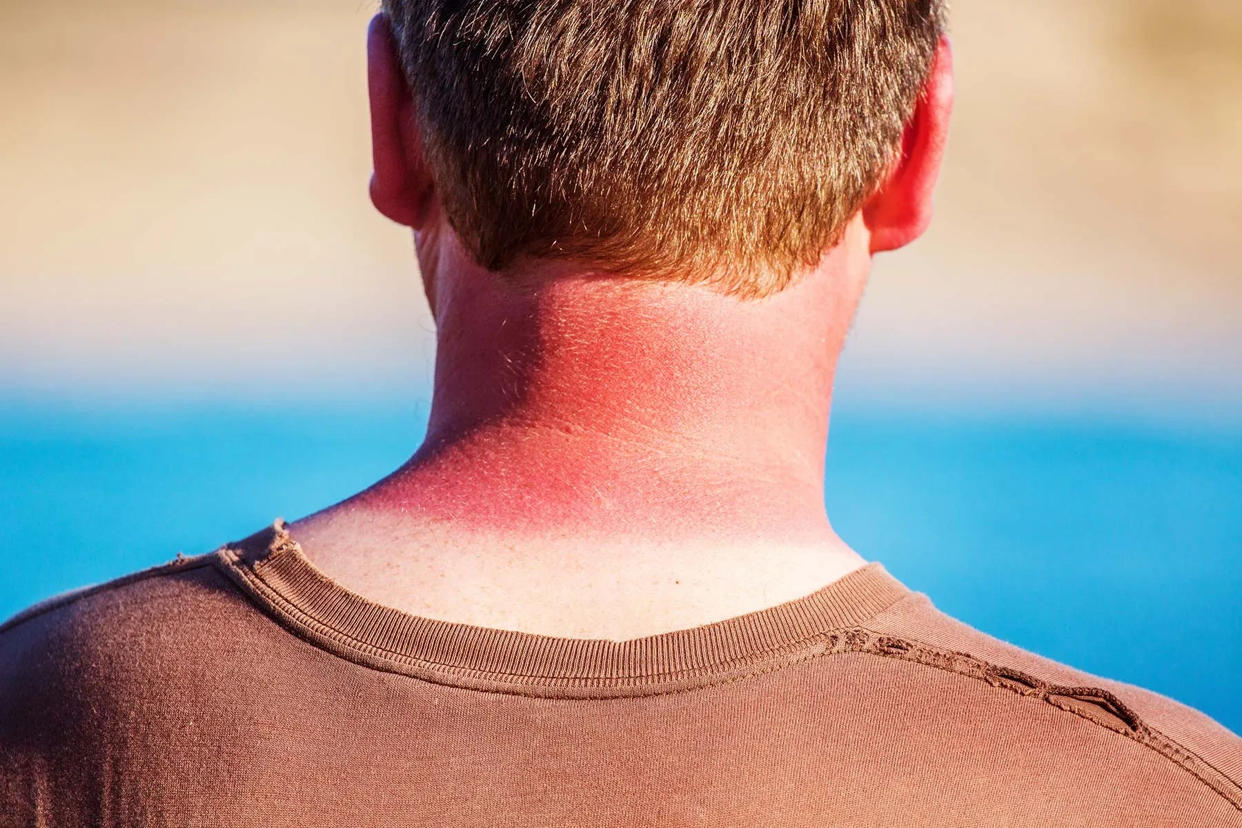 How Long Do Sunburns Last?
