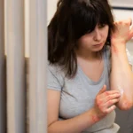 Woman applying ointment to a severe skin rash on her arm.